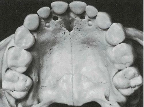 新生儿青色皮肤是不是胎记,新生儿青斑是中国人才有的吗
