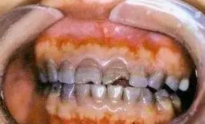 哪些药是对孩子有致聋风险,儿童十种致聋的药物