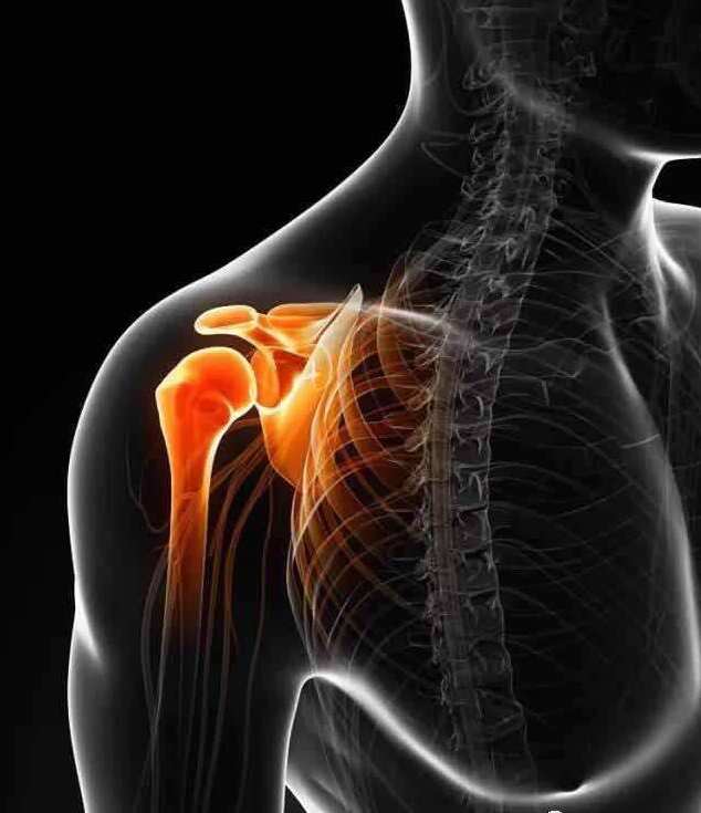 肩峰撞击综合征运动疗法,肩峰撞击综合症的锻炼