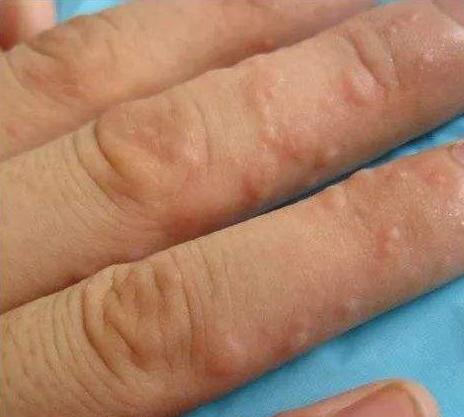 汗疱疹反反复复怎么治疗,汗疱疹反复发作怎么弄