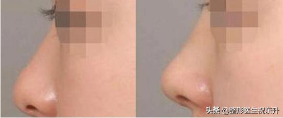 隆鼻只做鼻尖不垫假体可以吗,做隆鼻可以只做山根位置吗
