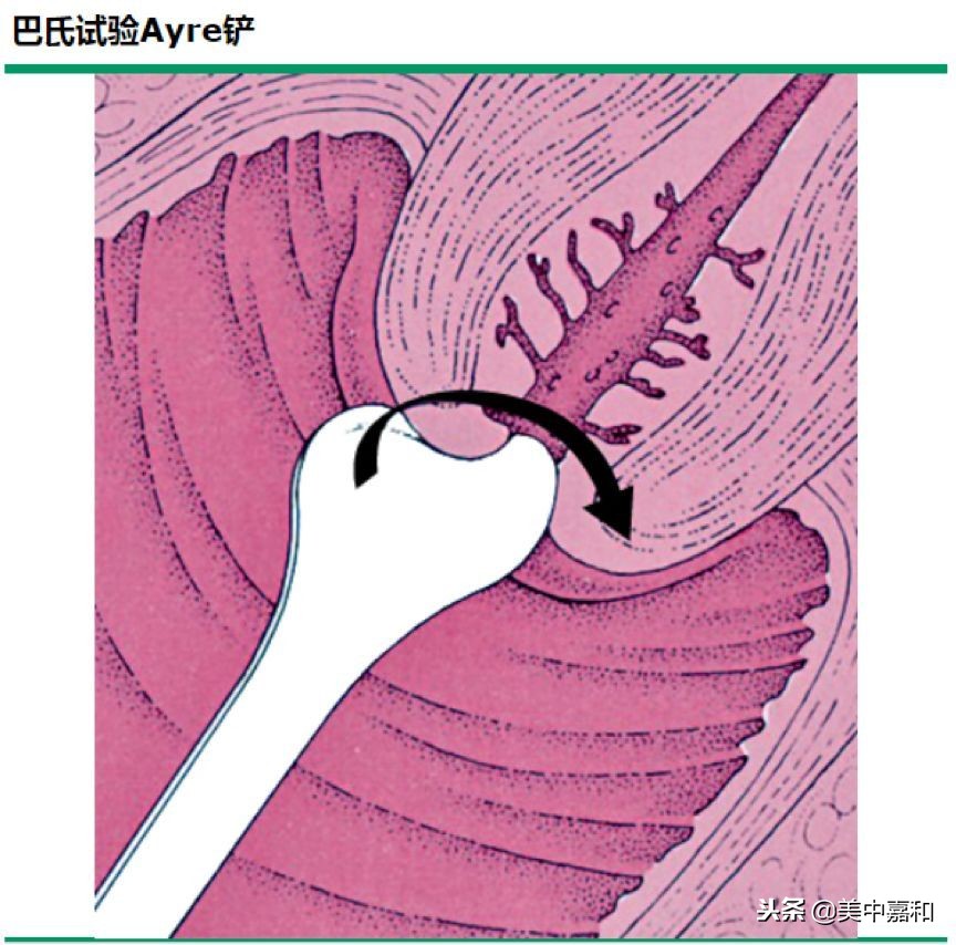 助人远离宫颈癌的“神器”—HPV检测和TCT检查,该怎么做?