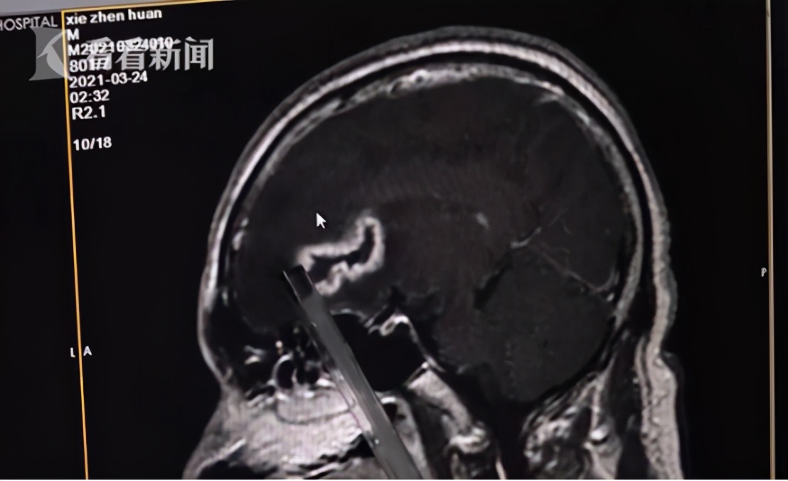 男子拔牙致死是什么原因,拔牙引起急性炎症