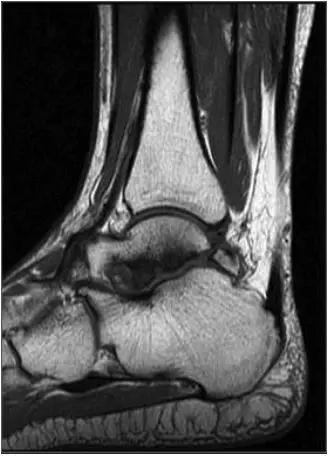 踝关节撞击症问诊,踝关节撞击综合征的x线表现