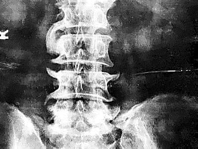 颈椎长骨刺该怎么治疗呢,颈椎骨刺有什么说法