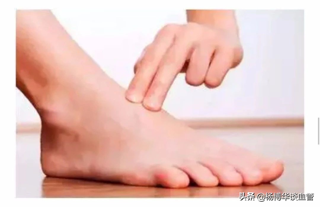 脚背能看见很多毛细血管有点不适,脚背上的血管是静脉吗