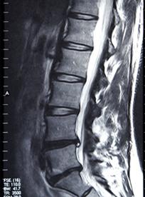 腰椎间盘突出有药酒可以治吗,腰椎间盘突出有药缓解吗