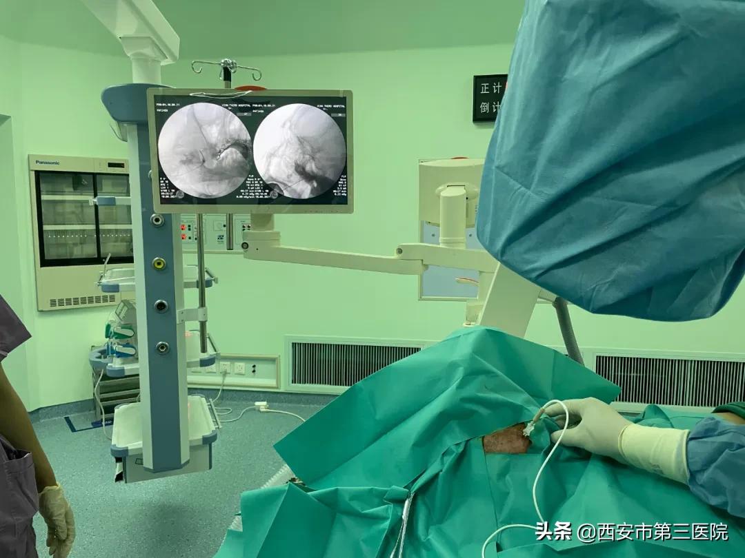 射频消融治疱疹神经疼多久康复,带状疱疹后遗神经痛消融术