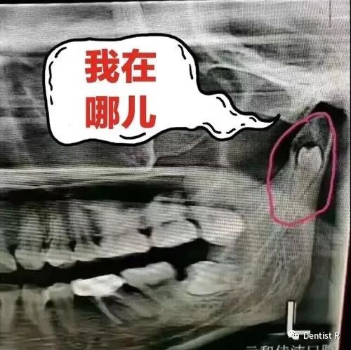 看牙为什么要拍照片,看牙拍片辐射大吗