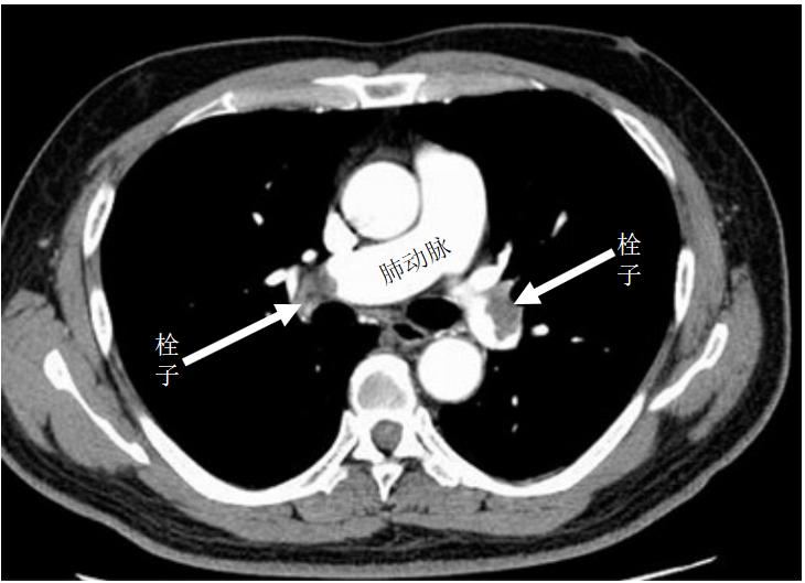 做好五件事远离血栓,做好这6点让你远离血栓的困扰