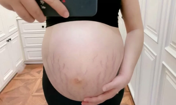 祛妊娠纹的产品亲测,明星用的祛妊娠纹产品