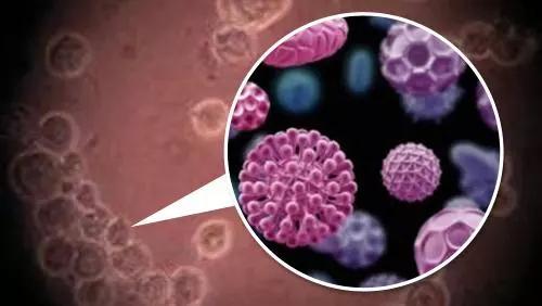 尖锐性湿疣反反复复很痛苦,得过尖锐性湿疣几年后还会感染吗