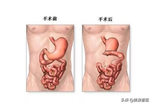 六个胃癌前病变,得了胃病不可再忽视