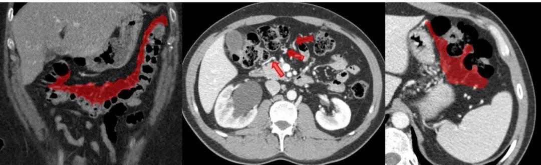 这样的解剖结构容易忘？重新认识肠系膜