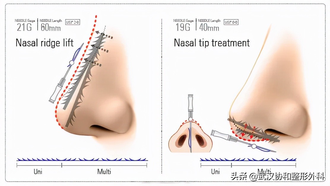 为什么不建议做线雕隆鼻手术,为什么不建议做线雕隆鼻