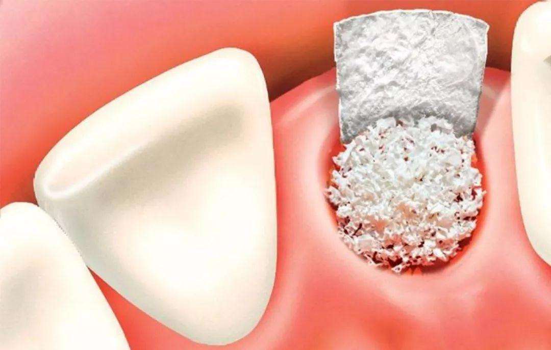 都说种植牙贵难道保护牙齿很难吗,谈谈种植牙对牙床的损害