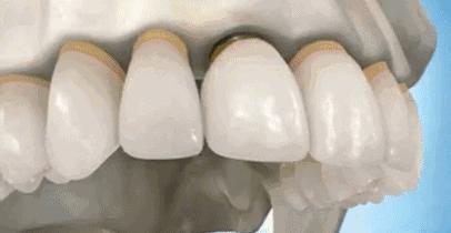 种植牙真的很好吗,种植牙副作用多吗