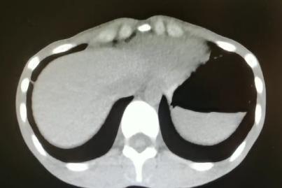 消化道出血高钾血症治疗,诊断高碳酸血症的金标准是什么