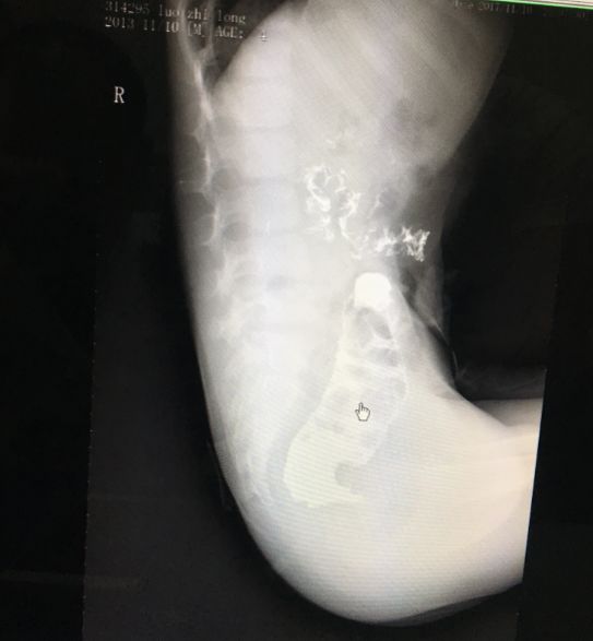 刚生下的男婴没肛怎么办,出生的孩子无肛直肠瘘