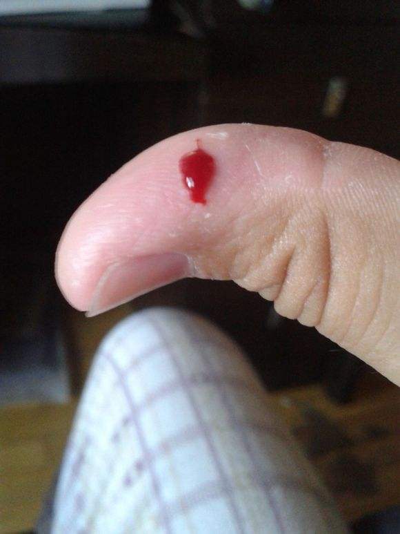 玻璃渣扎进心脏,玻璃渣子扎进血管多久会死