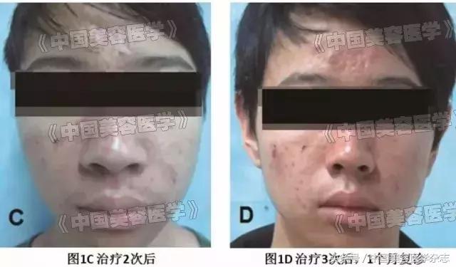 光动力治疗后出现脓包是什么情况,光动力治疗后脓包痘几天恢复