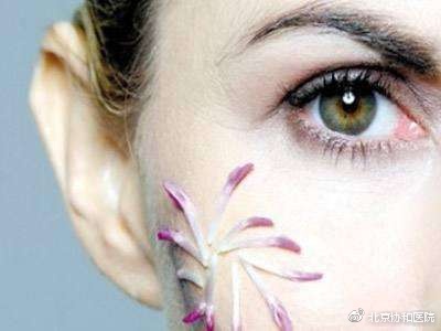 北京协和医院疤痕切除手术,北京协和治疗手术疤痕