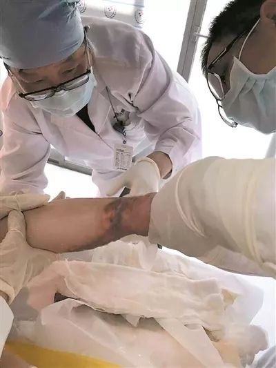 孩子烫伤后发低烧是怎么回事,烫伤三度怎么治疗