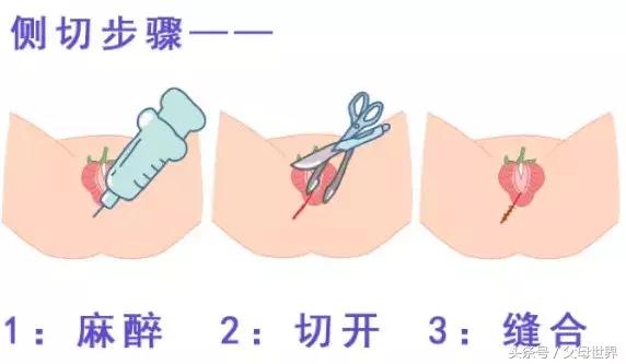侧切顺产会不会影响以后生活,侧切的十大危害