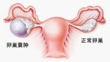 怀孕初期左侧卵巢囊肿是什么意思,卵巢囊肿是先怀孕还是先手术