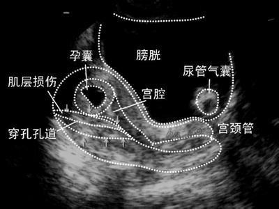 人工流产对女性伤害有多深,人工流产的危害有多大