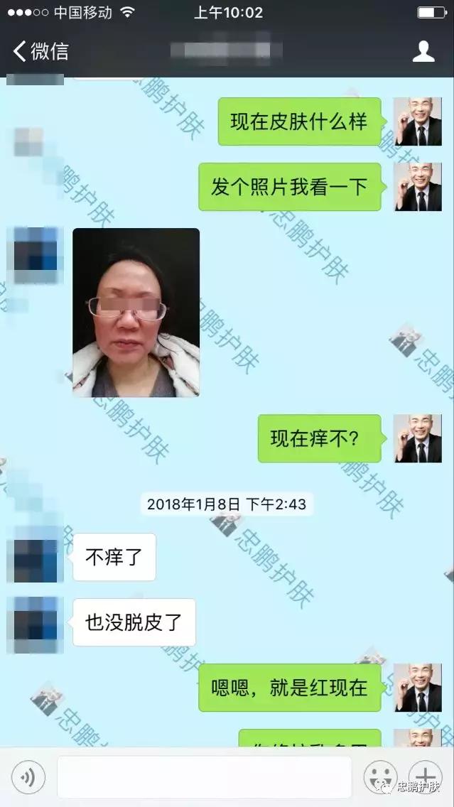 激素脸发红发热脱皮怎么办呢,激素脸为什么会扩散到脖子上代谢