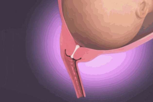 准妈妈见红是什么症状,孕妈妈见红是不是快生了