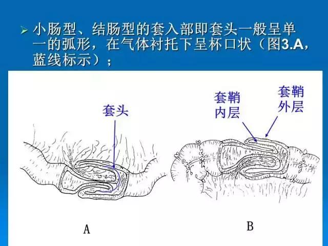 小儿肠套叠空气灌肠需要注意事项,儿童肠套叠空气灌肠要不要住院