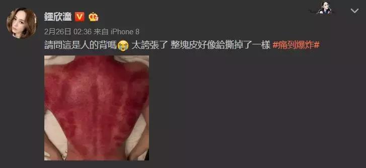 完全没想到!明星也如此痴迷刮痧和拔火罐…
