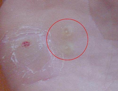 脚下出现老茧很严重该如何去除呢,脚下为什么长老茧