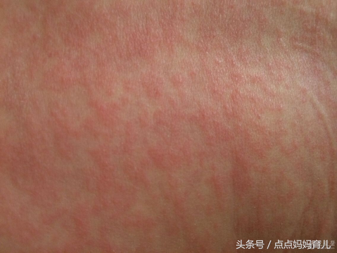 有两岁才得婴幼儿急疹的么,婴儿急疹出疹后饮食应注意什么