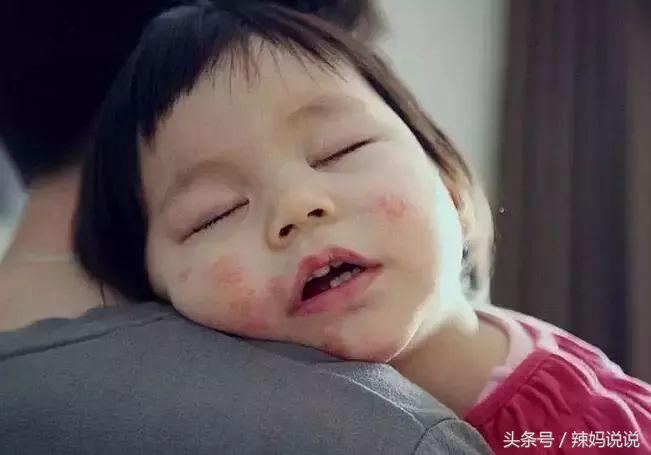 婴幼儿过敏了怎么办最快方法缓解,婴幼儿常见的五种过敏疾病