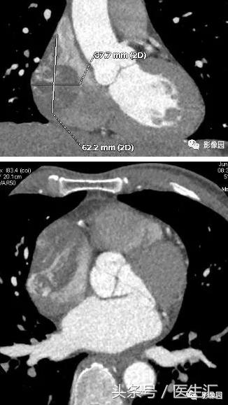 少见原发性心脏肿瘤