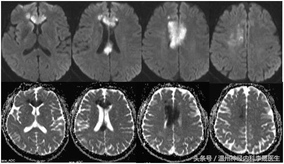 李医生讲中风，大脑前动脉堵塞的点点滴滴