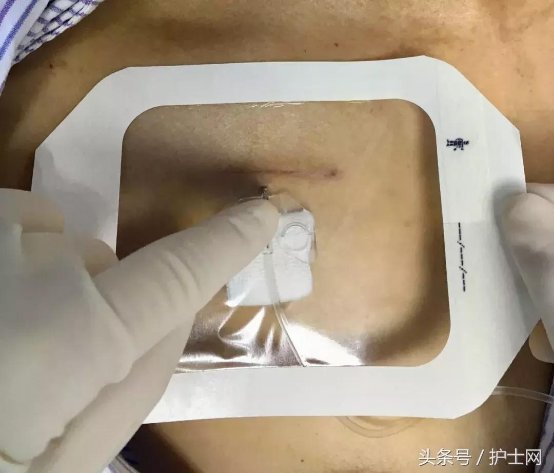 输液港扎针最全示范,输液港拔针的正确方法视频教程