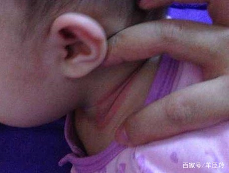 口水疹尿布疹特效药,宝宝水痘怎么护理