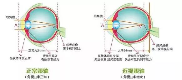 长期戴眼镜会导致面部变形吗,长期戴眼镜眼睛会变形