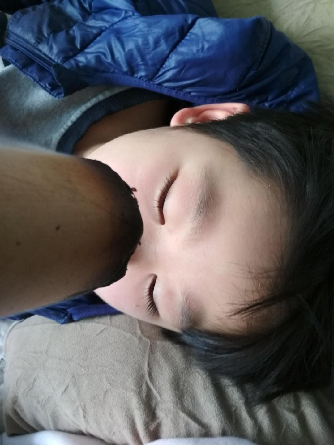 艾灸治疗鼻炎扁桃体肿大,腺样体扁桃体肥大艾灸有用吗