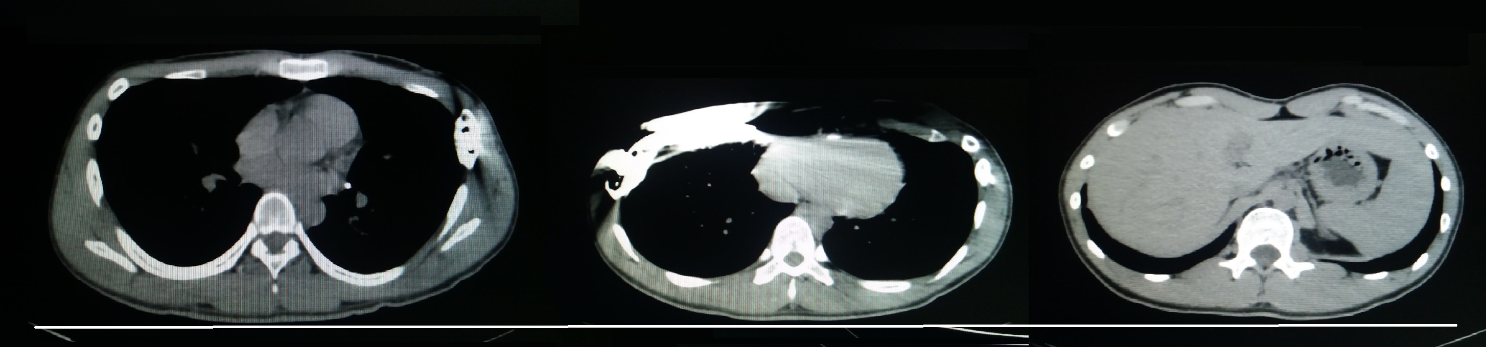 漏斗胸矫正微创手术,最新的漏斗胸微创手术