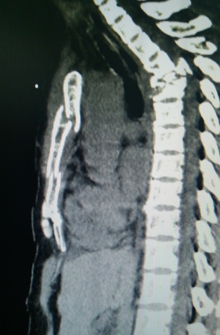 胸廓塌陷畸形自我矫正,胸廓畸形的标准是什么
