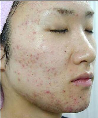 祛痘面膜真的可以祛痘吗,芙清祛痘面膜效果怎么样