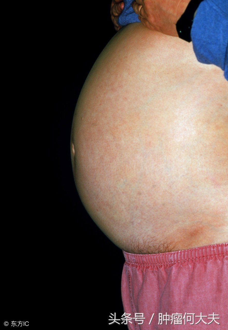 肿瘤晚期腹水怎么消除,癌症晚期腹水腹腔穿刺