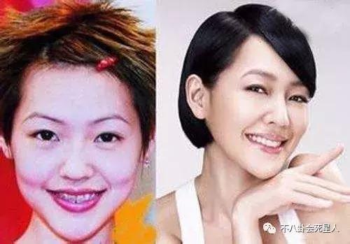 高圆圆戴牙套的脸型变化图,高圆圆戴牙套前后对比照