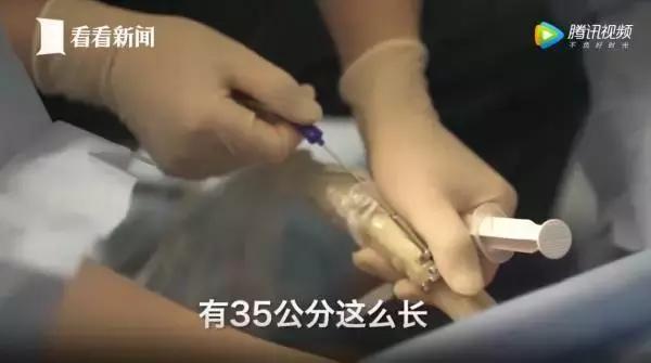 20岁女大学生捐卵,女大学生捐卵案