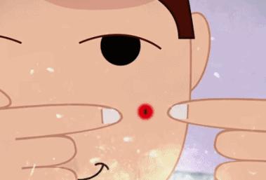 挤黑头痘痘粉刺闭口,怎么去除闭口痘